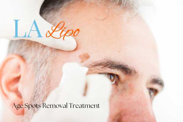What Are the Most Effective Treatments for Age Spots Cricklewood?