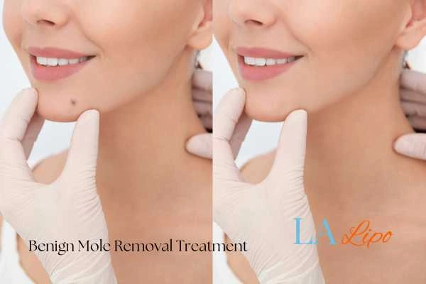 woman's before and after mole removal Cricklewood results