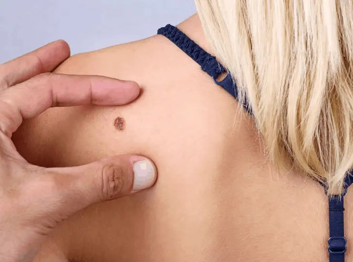 woman having mole removal Cricklewood consultation before treatment.