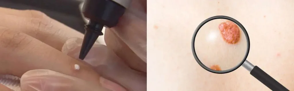 Cryopen for mole removal Cricklewood - speak to our team today!