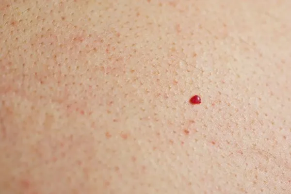 close up of a cherry angioma Cricklewood