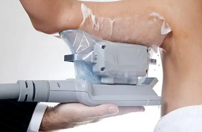 Picture of fat freezing Cricklewood on the upper arms.