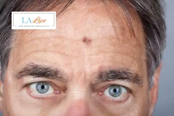 Solar Lentigo Removal Cricklewood image of man with mark on his forehead