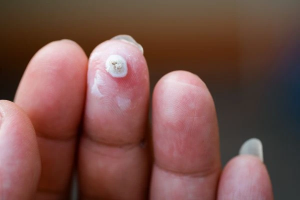 wart on person finger - cryotherapy to treat from LA LIPO Cricklewood