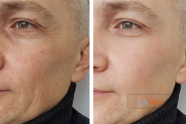 See the amazing results of Morpheus8 Treatment Cricklewood!