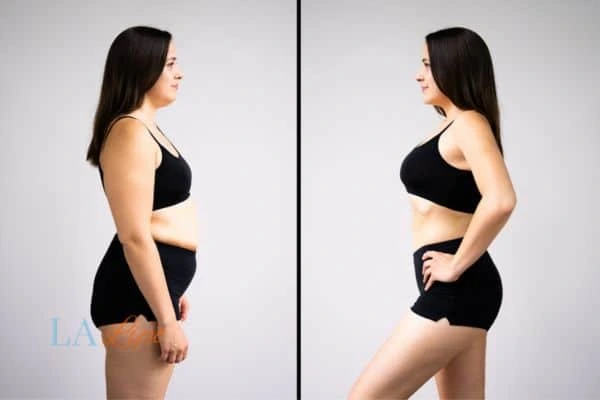 Picture of womans before and after using LA-EMS body sculpting to improve her core strength Cricklewood