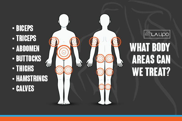 Diagram to show areas you can have LA-EMS Body Sculpting Treatment Cricklewood