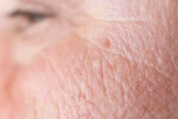 close up picture of a woman's face showing an age spot Cricklewood