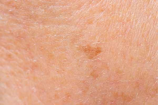 close up picture of age spots Cricklewood